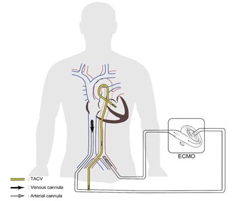 lv vent cannula|venting cannula for venoarterial ecmo.